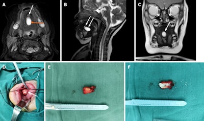 The infant during the second surgery. A: Second preoperative MRI of large mass and a tiny suspect lesion (white arrow). B: MRI in sagittal plane showing large high-signal (wide arrow) and tiny suspect (narrow arrow) lesions. C: MRI in coronal plane of one lesion only. D: Completely encapsulated mass. E: Fully removed lesion. F: Cross-section with keratin content.