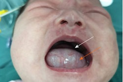 2020 08 21 21 08 9097 2020 08 Infant Cyst 1 400