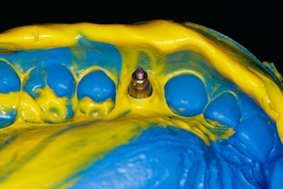 Impression Using Virtual Xd By Ivoclar Vivadent