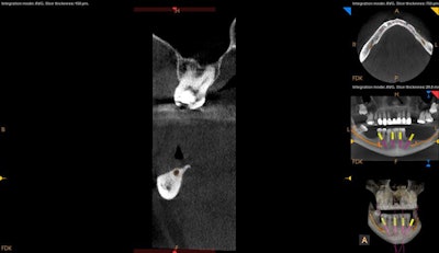 3D scan showing severely resorbed posterior mandible with minimal crestal bone coverage of the inferior alveolar canal (note the position of the alveolar crest). All images courtesy of Robert Pauley Jr., DMD.