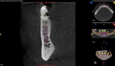 Angled implant treatment planning of the lower right posterior implant allows one to avoid the inferior alveolar nerve and it's anterior loop as well as to increase the A-P spread.