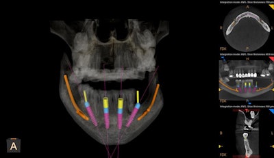 3D view showing all implants treatment planned, with the slice of lower right posterior implant shown in the views to the right. The CS 3D imaging software allows placement of straight and angled multiunit abutment planning.