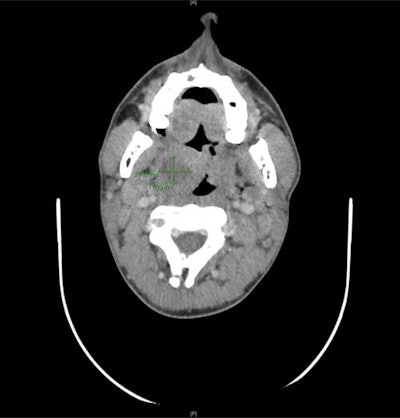 Computed tomography scan of a peritonsillar abscess in a 21-year-old man. All images courtesy of BMJ Case Reports.