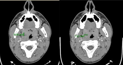 CT results after treatment of the abscess.