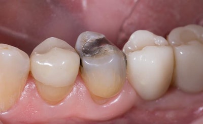 Figure 1: Large, failing distal-occlusal-buccal (DOB) amalgam restoration with mesial recurrent decay, mesial marginal ridge crack, and buccal cuspal attrition and wear facet. All images courtesy of Karyn Halpern, DMD.