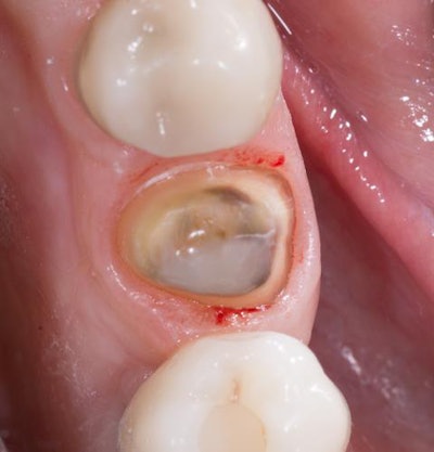 Figure 2: Occlusal view of final preparation after completion of composite core buildup and refinement.