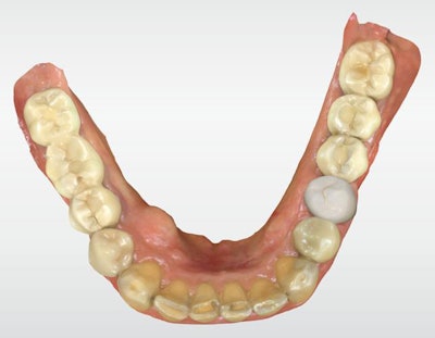 Figure 3: Final design of restoration (occlusal view).