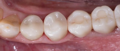 Figure 5: Occlusal view of final seated restoration #20 after cementation completed with Panavia SA Cement Universal and Clearfil Universal Bond Quick.