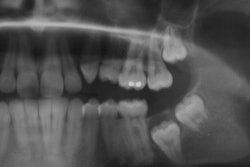 2020 09 15 18 12 0738 X Ray Third Molar2 400