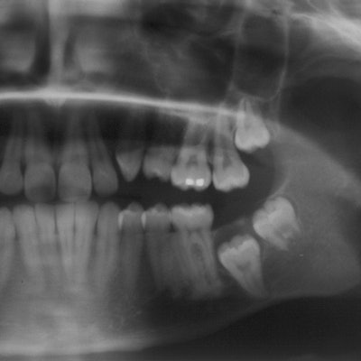 2020 09 15 18 12 0738 X Ray Third Molar2 400