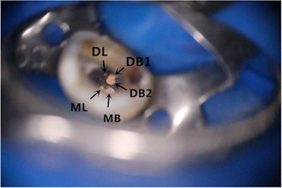 Orifices of the five root canals of the tooth with obturation under the microscope. Mesiobuccal (MB), distobuccal 1 (DB1), distobuccal 2 (DB2), mesiodistal (ML), and distolingual (DL). All images courtesy of Ming Zhang, PhD, et al. Licensed under CC BY-NC 4.0.