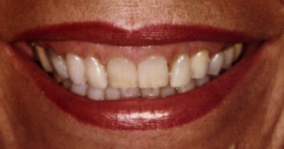 The patient before treatment. All images courtesy of Dr. Joe Blaes.