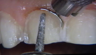 Precision prepping with a Bien-Air electric handpiece and protecting the tissue with the Zekrya.