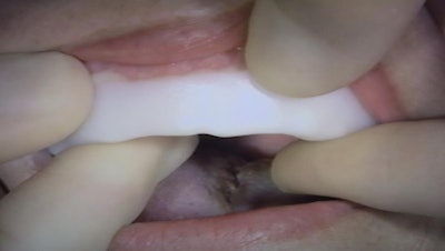 Matrix button stent making provisionals.