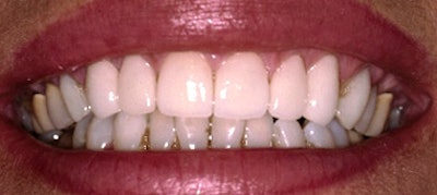 New smile with veneers.