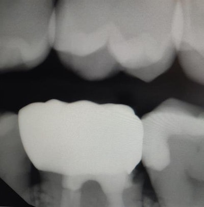 Before (above) and after (below) images of the crown for Cummings' patient. Images courtesy of Dr. Johnasina Cummings (and released for publication by the patient).