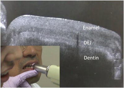 SS-OCT was used on the anterior tooth to provide real-time cross-sectional imaging. The right side of the image shows enamel and dentin, as well as the dentin-enamel junction appearing as a border between the two structures. All images courtesy of Shimada et al. Licensed under CC BY-NC 4.0.