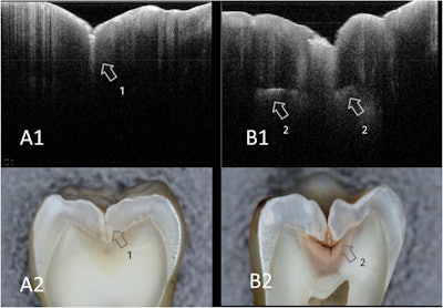 SS-OCT images of occlusal caries (A1, B1) and corresponding histological view after cross-sectioning (A2, B2). Enamel demineralization at the occlusal fissure is imaged as increased brightness within the depth of the dentin-enamel junction (arrow 1). The presence of hidden dentin caries is depicted in SS-OCT as backscattering signal from the lesion boundary (B1). Lesion expands along the dentin-enamel junction, appearing as a bright line (arrow 2).