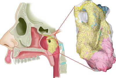 An interactive 3D reconstruction of histological slides of the newly identified gland. Schematic representation of region of the torus tubarius with overlying gland, in its anatomical setting (left) and as 3D histology reconstruction (right). The glandular tissue is shown in yellow (acini) and light blue (ducts). The dorsomedial view shows how the tubarial gland relates to the underlying torus tubarius cartilage (dark blue) and muscle (pink). All images courtesy of Valstar et al. Licensed under CC BY-NC 4.0.