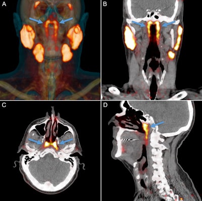 PSMA-PET projected as orange signal on reference CT. The parotid, submandibular, and sublingual salivary glands abundantly express PSMA. An unknown structure in the nasopharynx showed similar imaging characteristics (arrows). Location and extent of the tubarial glands in a random patient. Shown are coronal (B), axial (C), and sagittal (D) slices at the level of the torus tubarius of PSMA-PET projected as yellow signal on grayscale CT. The glandular structure is visible as PSMA-positive tissue (arrows). The coronal slices also show some parts of the parotid and submandibular glands, which demonstrate similar imaging characteristics.