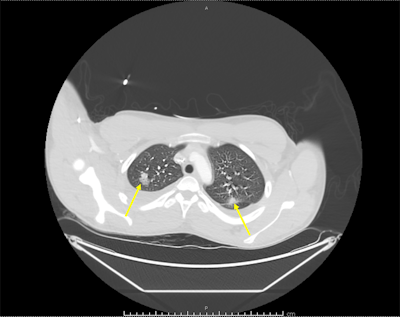 The arrows illustrate bilateral pulmonary infiltrates on a chest computed tomography (CT) scan with contrast. Images courtesy of Keshary et al. Licensed under CC BY-NC 4.0.