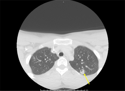 The arrow indicates interval development of cavitation that was later seen in nodular infiltrates consistent with septic emboli.