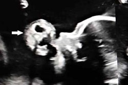 2020 11 18 18 23 0918 2020 11 19 Fetal Teratoma1 20201118182357
