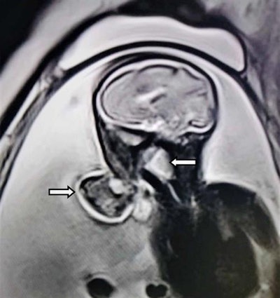 Sagittal MRI scan shows a mixed-intensity mass with a stalk protruding through the jaws into the amniotic fluid.