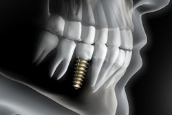 2019 12 10 19 28 1071 Implant 3 D2 400