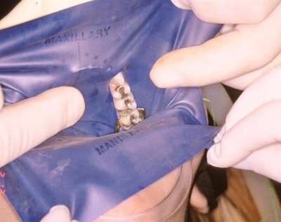 Place A Rubber Dam Clamp On The Most Distal Tooth In The Quadrant