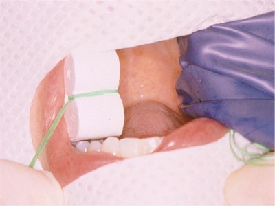 Put The Rubber Dam Over The Clamp And Stretch It Forward To The Cuspid