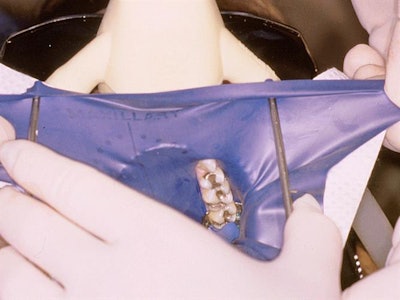 Stretch the dam onto the rubber dam holder