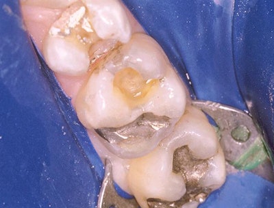 Ready To Prep Teeth