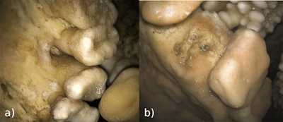 (A) Tooth loss that occurred prior to death. (B) This shows the socket of LM1 with a well-defined space for three roots. There are no evident marks of bone resorption.