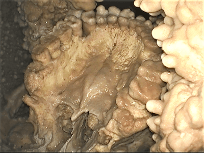 This view of the maxillary dental arch and palate shows a well-marked palatine torus.