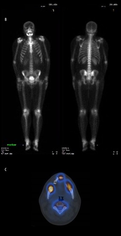 Whole Body Bone Ct Shows Increased Uptake In The Mandible Spect/Ct Shows A High Rate Of Metabolic Activity In The Same Regions