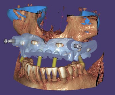 The new exoplan 3.0 Galway release. Image courtesy of PRNewsfoto/Exocad.
