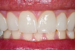 2016 09 13 10 25 03 345 Teeth Veneers 400