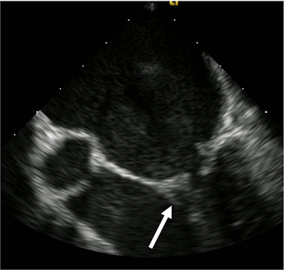 The transesophageal echocardiogram shows a small, independently mobile linear echodensity on the posterior leaflet of the mitral valve (white arrow). This is consistent with vegetation. Image courtesy of Bridwell et al. Licensed under CC BY-NC 4.0.