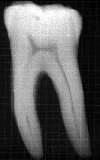 Figure 1: Calcified mandibular molar. All images courtesy of Dr. Allan Deutsch.