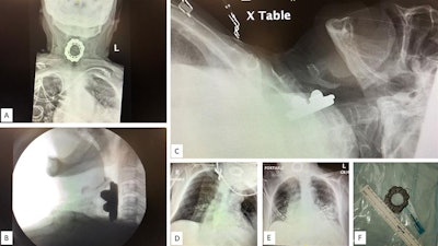 (A) Anteroposterior chest radiograph displaying a spinning-top toy in the woman's hypopharynx. (B) Upright lateral neck radiograph. (C) Supine lateral neck radiograph. (D) Wide-angle anteroposterior neck radiograph. (E) Wide-angle anteroposterior neck radiograph. (F) Extracted toy with 3-cm diameter. Images courtesy of Dr. David Gerth. Licensed under CC BY-NC 4.0.