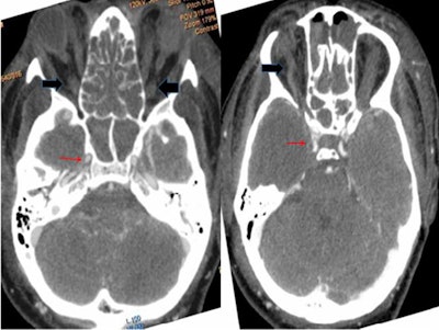 Axial CT angiography shows normal enhancement of cavernous carotid artery (red arrows) with thrombosed and dilated superior ophthalmic veins (black arrows).