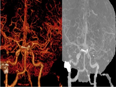 Reconstructive 3D image shows cavernous sinus thrombosis with patent carotid artery system. All images courtesy of Aljanabi et al.