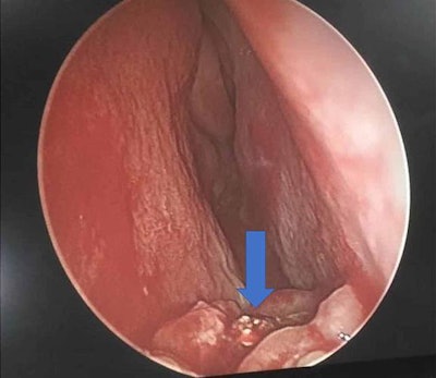An endoscopic view of the patient's left nasal cavity. There was a hard, whitish mass (blue arrow) at the floor of the cavity.