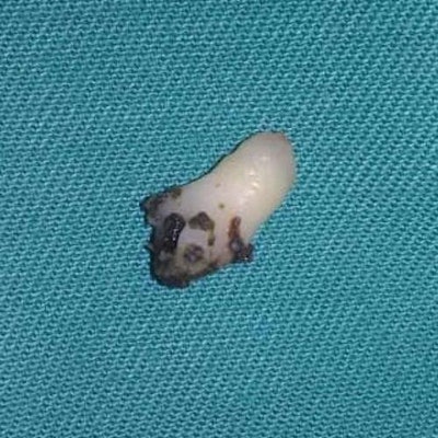 The tooth retrieved from the nasal cavity. All images courtesy of Ong et al. Licensed under CC BY-NC 4.0.