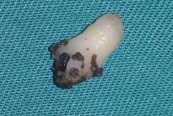 2021 03 08 23 04 5360 2021 03 09 Intranasal Tooth 3 20210308233236