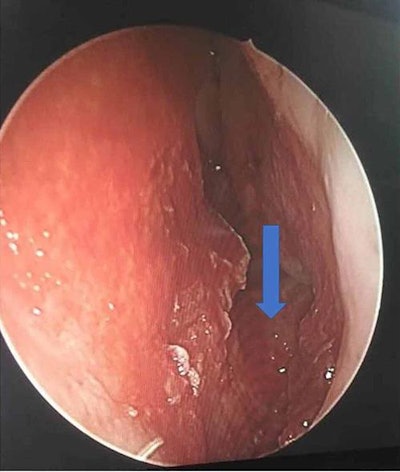 An endoscopic view of the woman's nasal cavity after tooth removal. The nasal cavity floor appeared intact (blue arrow).