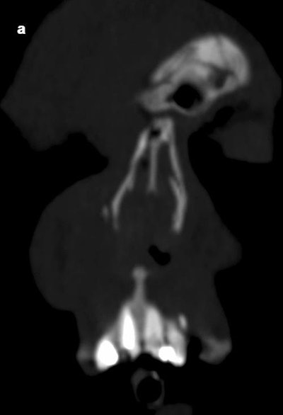 (A) Maximum intensity projection CT scan in the coronal plane of a 21-year-old man with a root fracture of the left upper incisor. The man had a complex skull fracture yet no direct adjacent fracture to the tooth. The radiologist failed to report this dental finding. (B) The tooth fragment is also visible in the axial plane. Images courtesy of Meyer et al. Licensed under CC BY-NC 4.0.