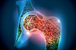 2021 04 06 20 34 8084 Osteoporosis Hip Joint 400