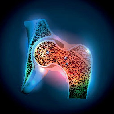 2021 04 06 20 34 8084 Osteoporosis Hip Joint 400